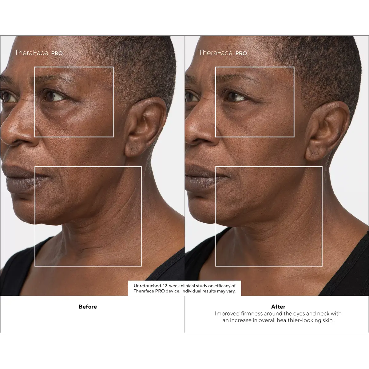 Therabody TheraFace PRO Facial Health Device - White Photo 3