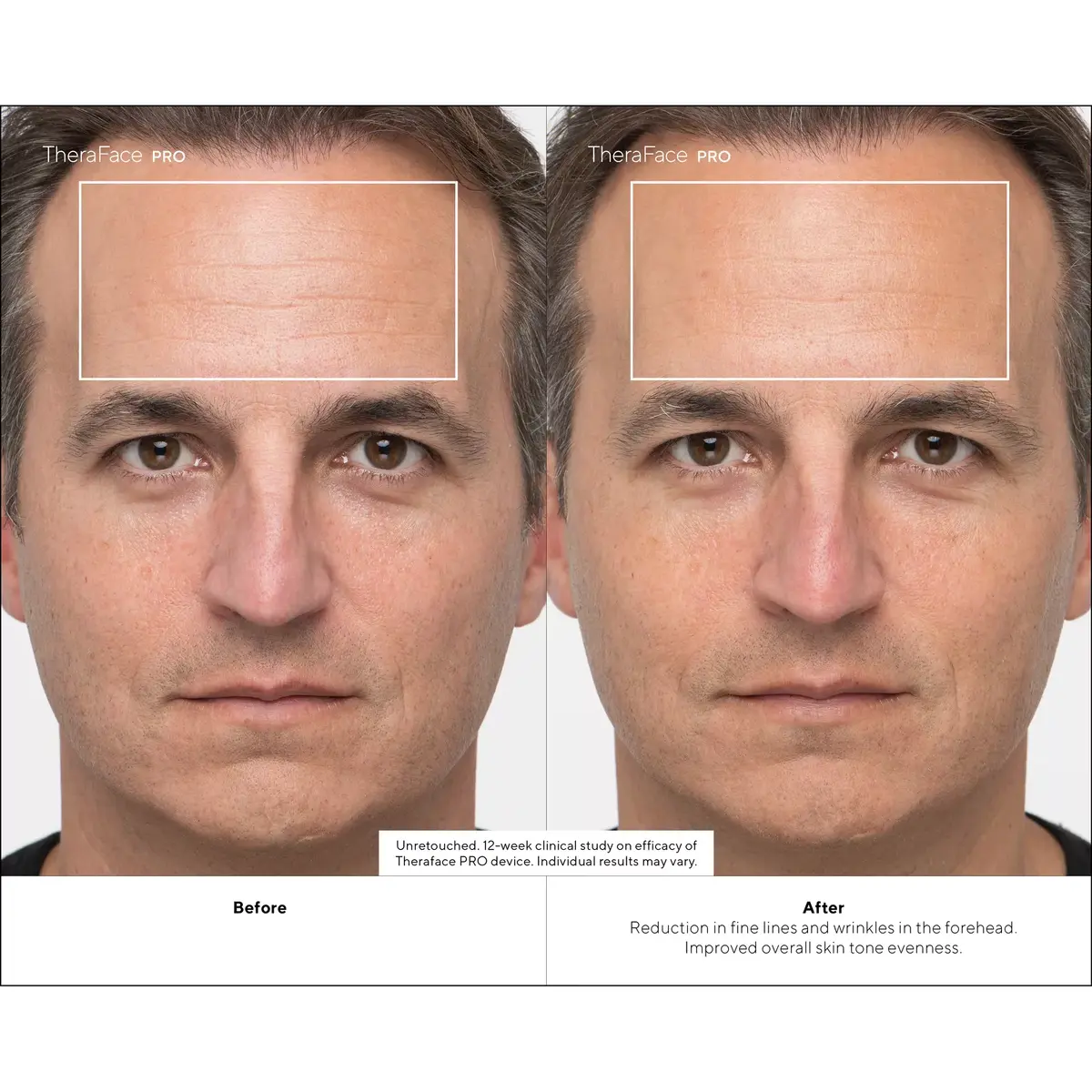 Therabody TheraFace PRO Facial Health Device - White Photo 4