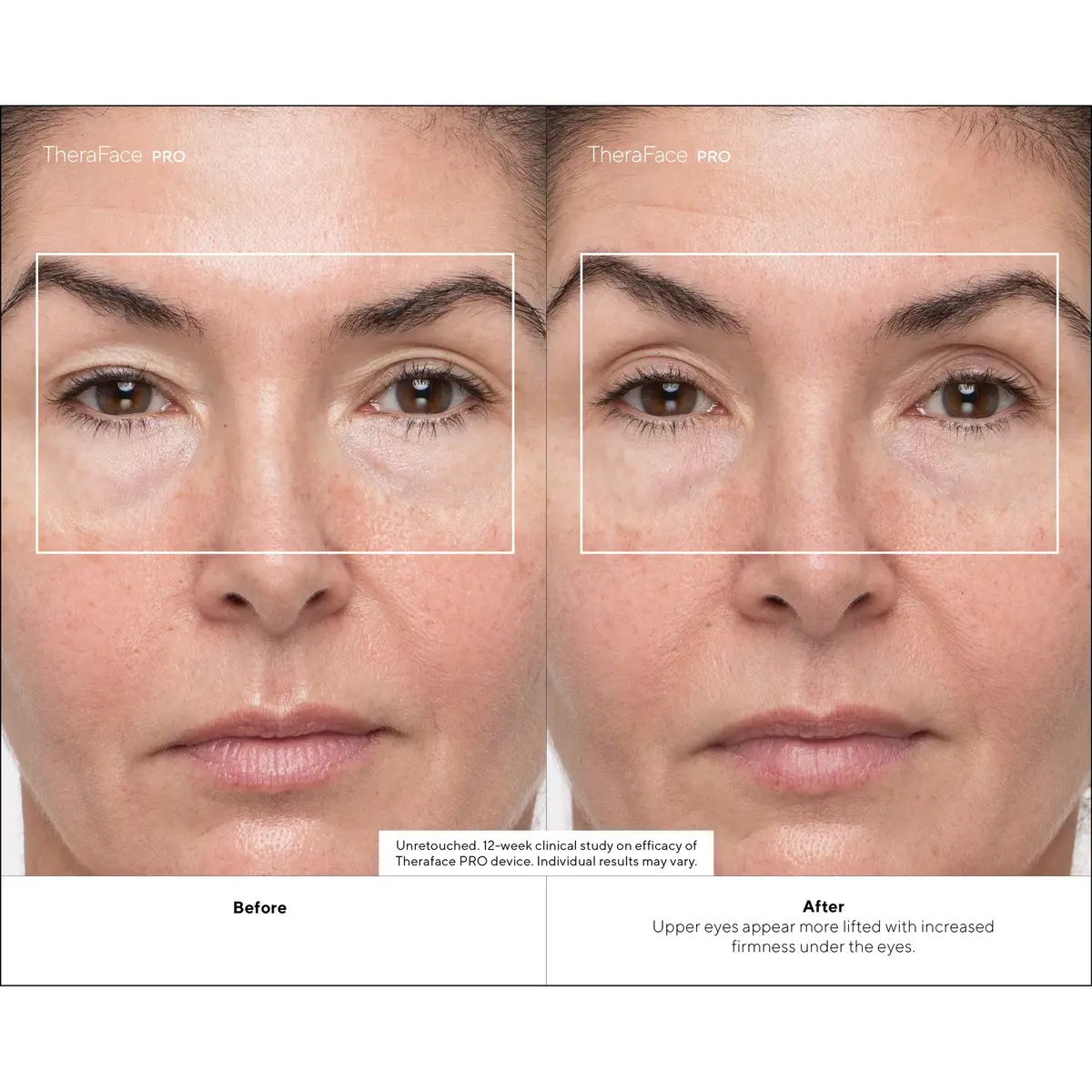 Therabody TheraFace PRO Facial Health Device - White Photo 5